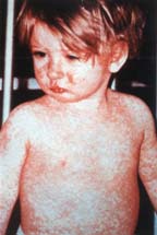 Child with measles rash on face and body